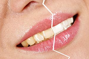 Вопросы об отбеливании зубов