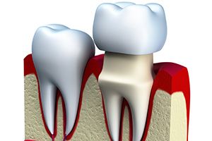 Металлокерамические коронки в стоматологии ДенталАрт