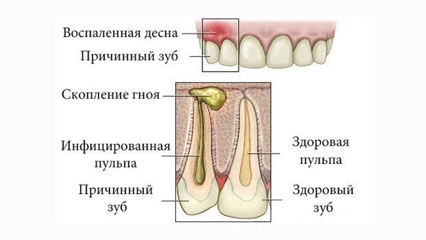 абсцесс зуба