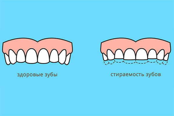 Стираемость зубов - причины и лечение