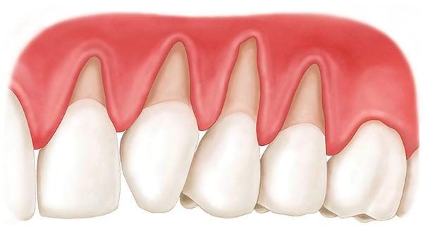 Симптомы клиновидного дефекта зубов