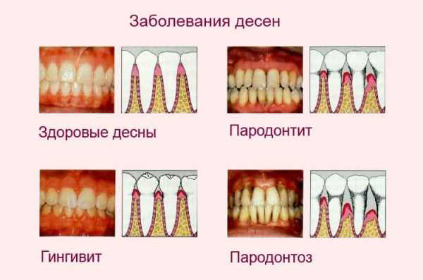 Виды заболеваний десен Детская стоматология Томск Карла Маркса