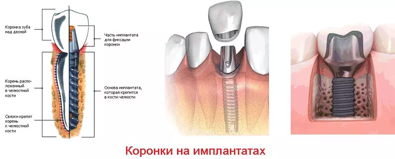 Шатается коронка на импланте: что делать?