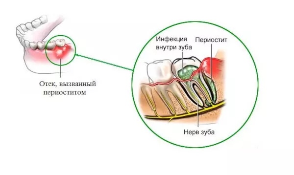 Отек вызванный периоститом