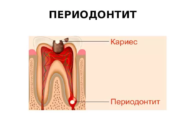 Периодонтит