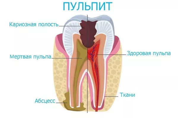 Пульпит