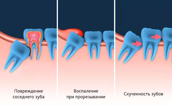 Причины удаления зуба мудрости