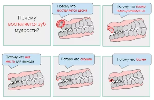 Почему зубы мудрости растут не у всех?