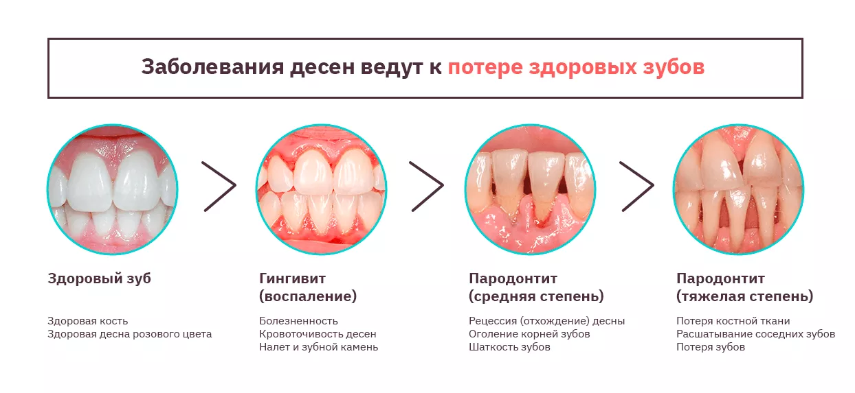 Как лечить пародонтоз в домашних условиях и народными средствами