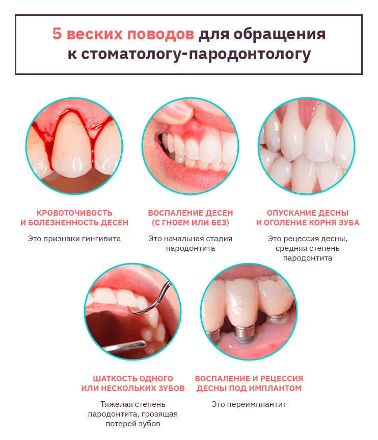 Лечение пародонтоза, воспаление десен, лечение пародонтита