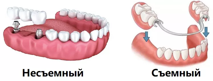 Протезирование зубов