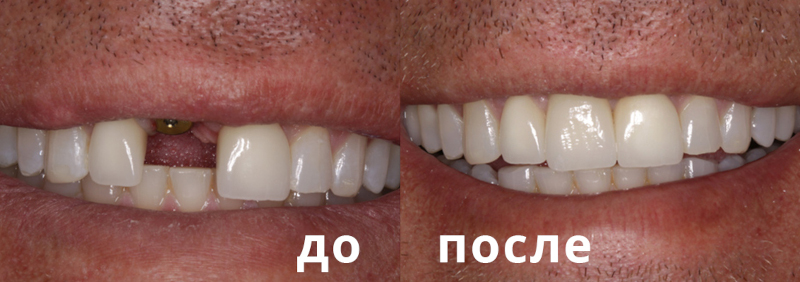 Результат имплантации одного зуба